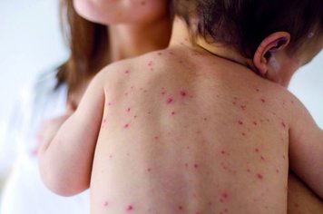 SARAMPO: crianças que se deslocarem para municípios em situação de risco devem ser vacinadas